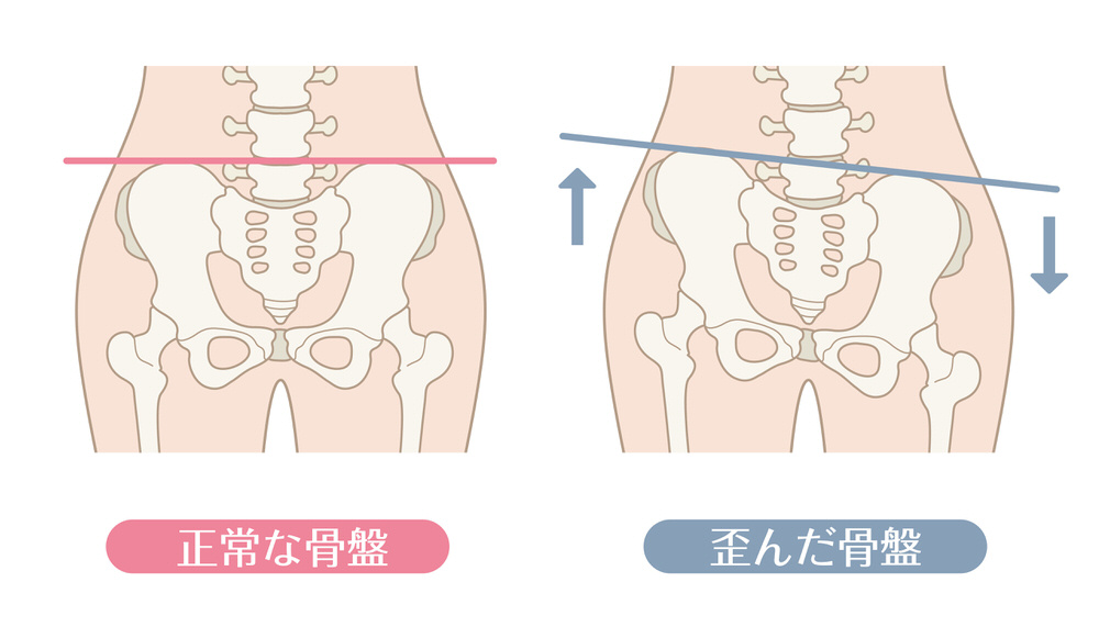 骨盤が歪むことによる不調